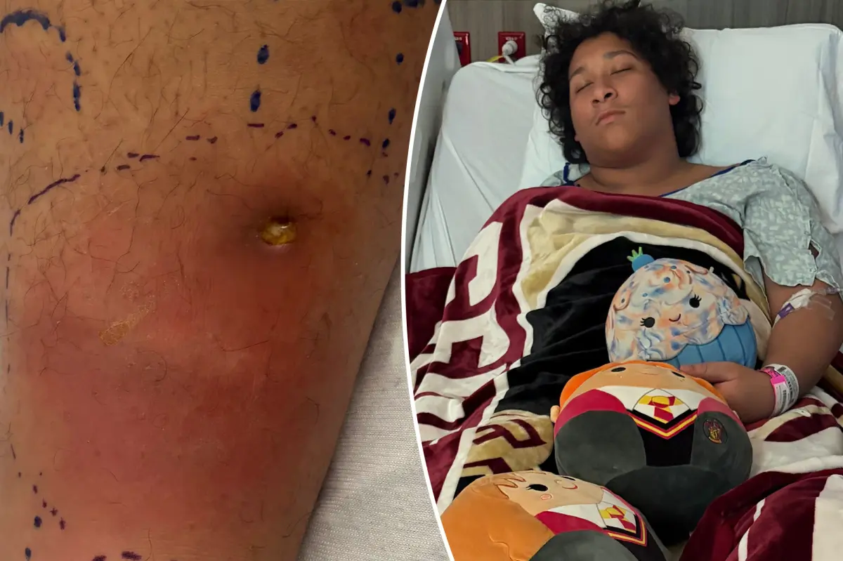 Teen ‘fighting for his life’ after contracting flesh-eating bacteria from swimming in Florida park