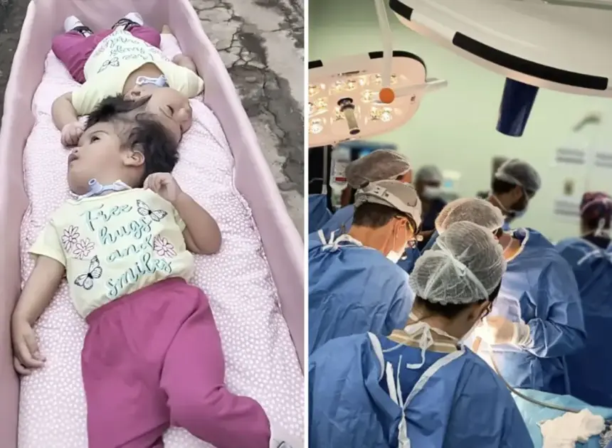 Conjoined twin girls, 2, die in desperate surgical operation minutes after being separated