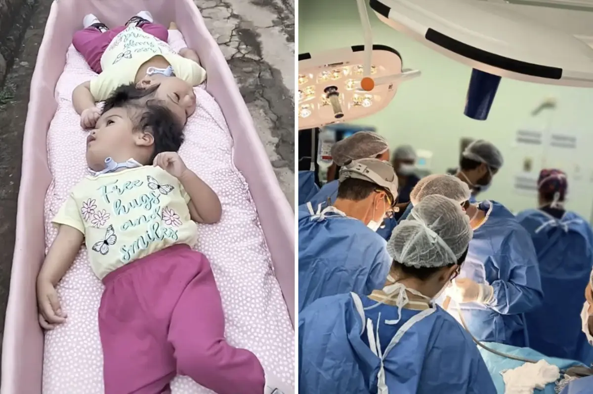 Conjoined twin girls, 2, die in desperate surgical operation minutes after being separated